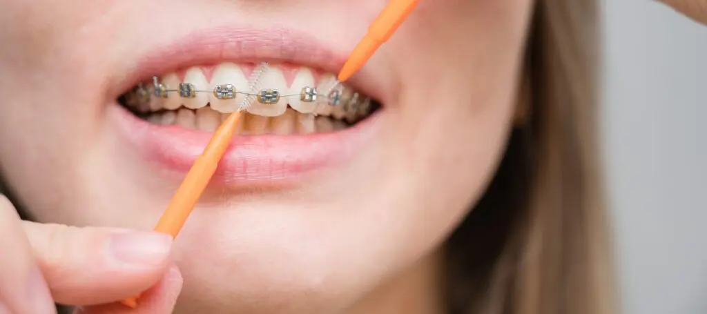 A close-up image of a person with braces using an interdental brush to clean between their teeth.