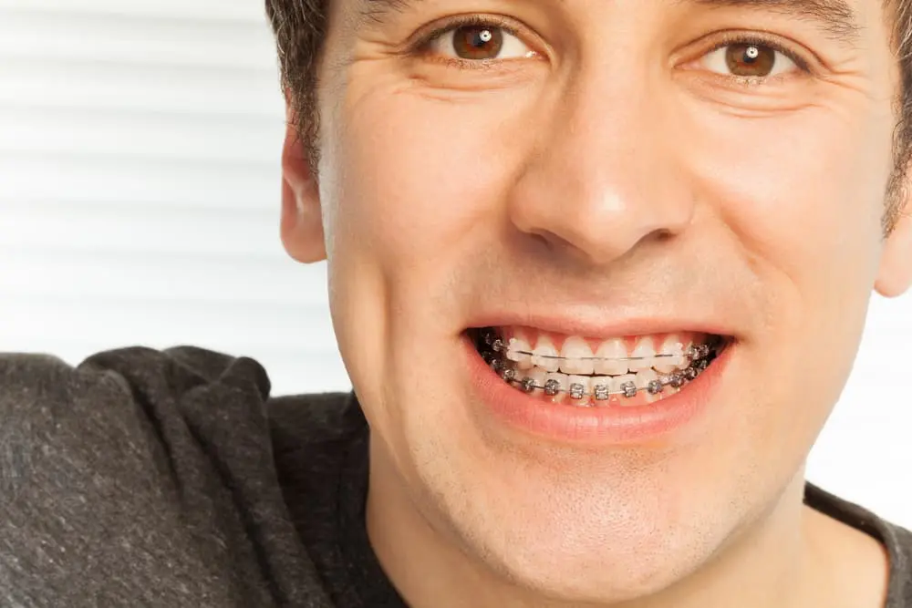 Image of a smiling young man with ceramic braces. Learn about the comparison of ceramic braces to clear aligners offered in Liberty Township and Hamilton, OH.