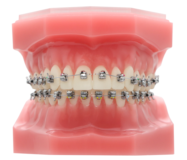 A dental model of human teeth with metal braces applied on both the upper and lower rows of teeth.