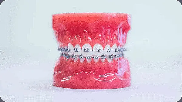 The dental model elegantly displays metal braces on upper and lower teeth, set against a pink gum base in Liberty Township or Hamilton, OH