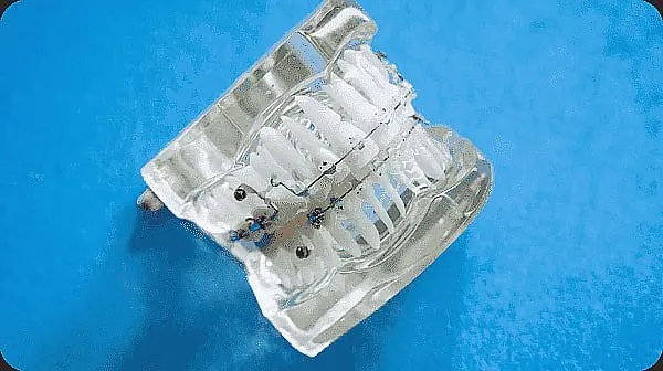 A clear dental retainer with sleek metal braces is elegantly placed on a blue surface in Liberty Township or Hamilton, OH