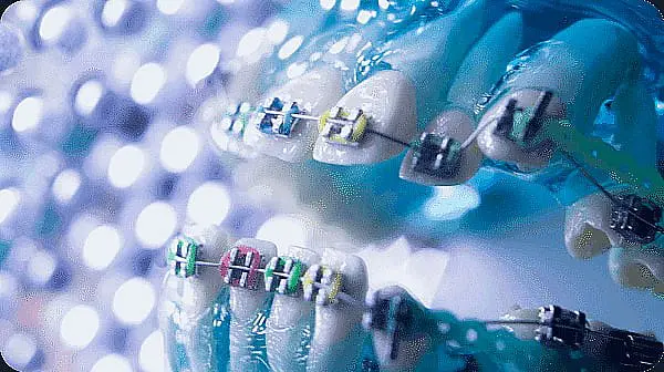 Close-up of a dental model with metal braces, showcasing colorful bands on the teeth. The model is surrounded by a textured, blurred background in Liberty Township or Hamilton, OH