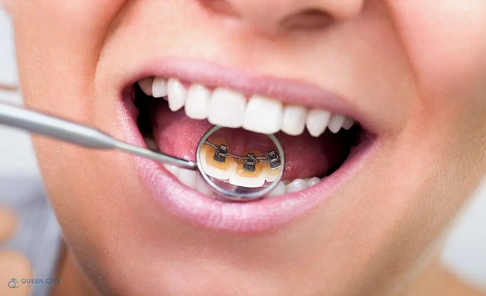 Close-up of a person’s open mouth revealing teeth with lingual braces, viewed through a dental mirror held by a tool as one of the Alternatives to Braces in Liberty Township or Hamilton, OH