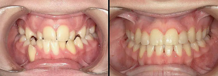 Side-by-side images showing teeth before and after orthodontic treatment; left shows crowded, misaligned teeth, right shows straightened, aligned teeth at Queen City Orthodontics in Liberty Township, OH.