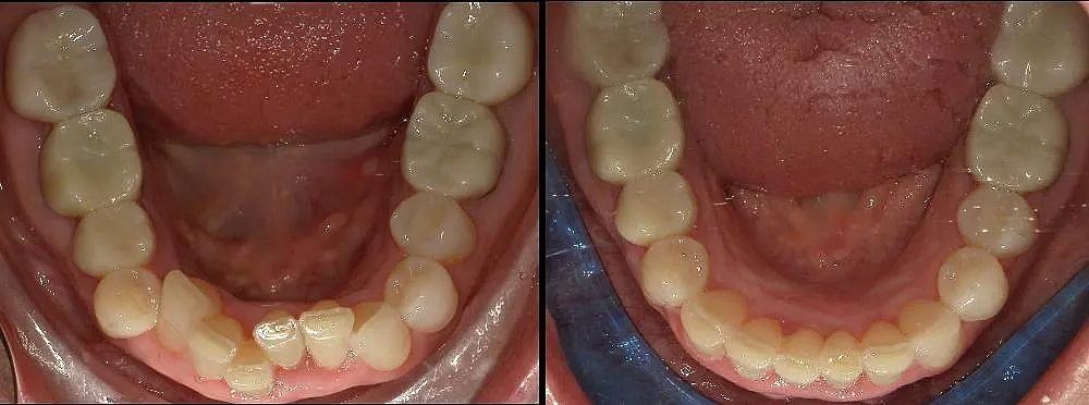 Two side-by-side images showing a lower jaw before and after dental treatment; the left shows crowded teeth, the right shows aligned teeth at Queen City Orthodontics in Liberty Township and Hamilton OH.