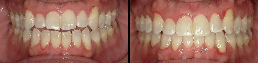 Side-by-side comparison of teeth before and after dental treatment; left shows a gap between upper and lower teeth, right shows aligned teeth with no gap at Queen City Orthodontics in Liberty Township and Hamilton OH.