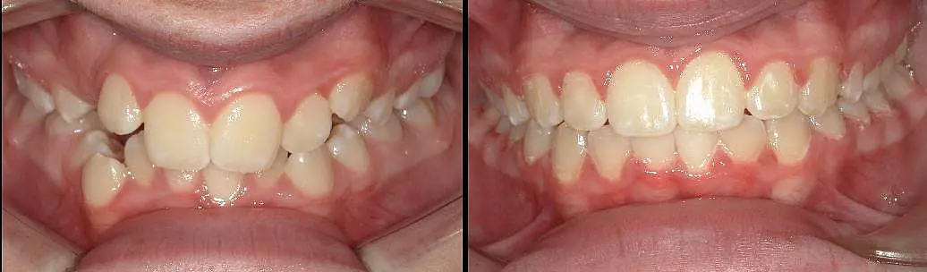 Side-by-side comparison of teeth before and after orthodontic treatment; left shows crowded, misaligned teeth, right shows straightened teeth at Queen City Orthodontics in Hamilton, OH.