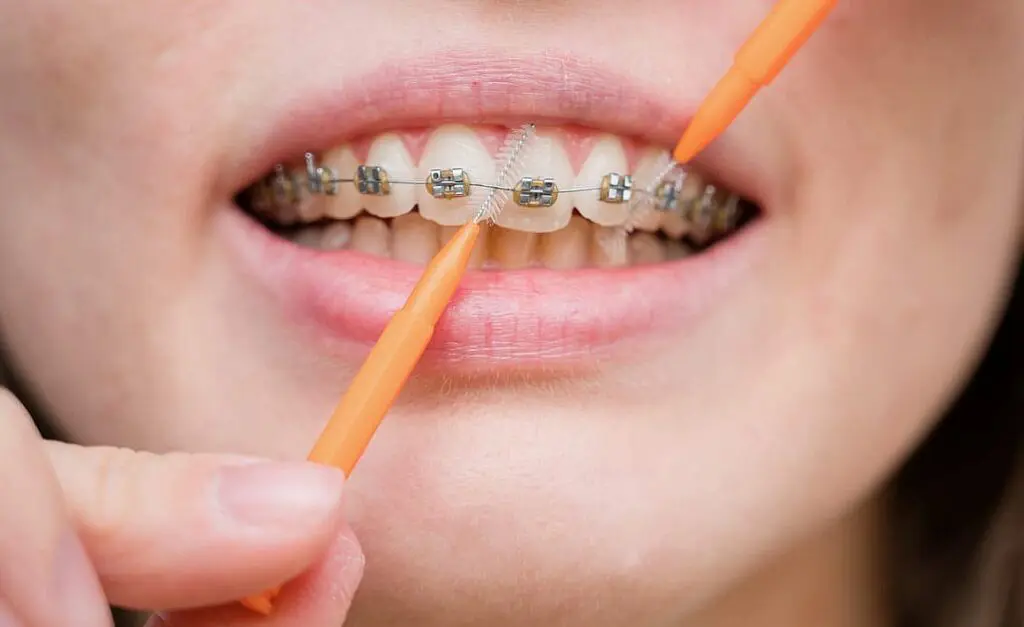 A close-up image of a person with braces using an interdental brush to clean between their teeth at Queen City Orthodontics in Liberty Township and Hamilton OH.