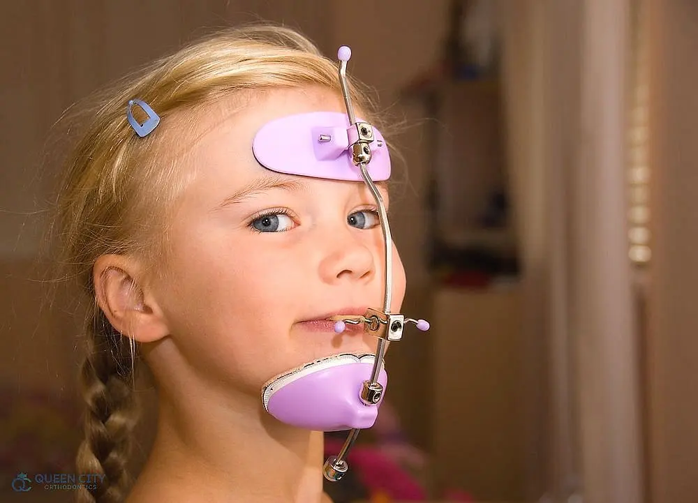 A young girl is shown wearing a Reverse Pull Headgear Braces in Liberty Township and Hamilton, OH on her forehead, chin, and mouth
