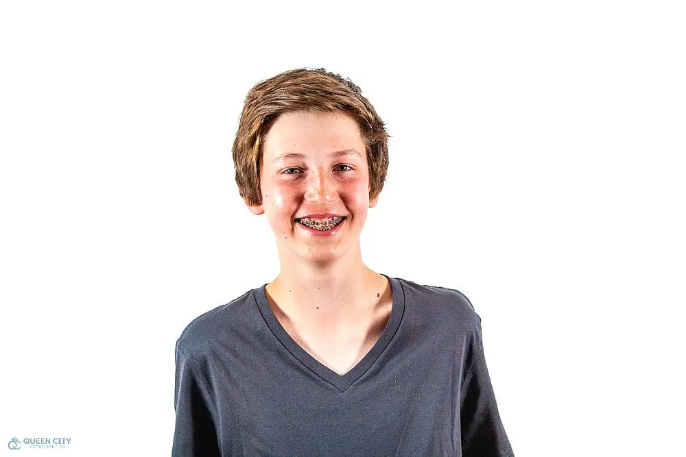 A teenage boy with short brown hair and a dark gray V-neck T-shirt smiles at the camera against a plain white background, representing how to fix overbite in Liberty Township or Hamilton, OH.