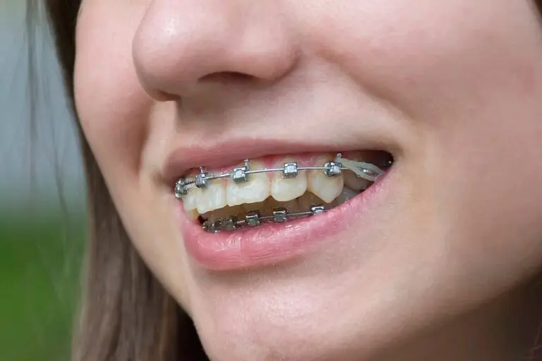 A close-up of metal braces with a white orthodontic elastic band is featured in this image, representing Queen City Orthodontics' braces for overbite in Hamilton and Liberty Township, OH.