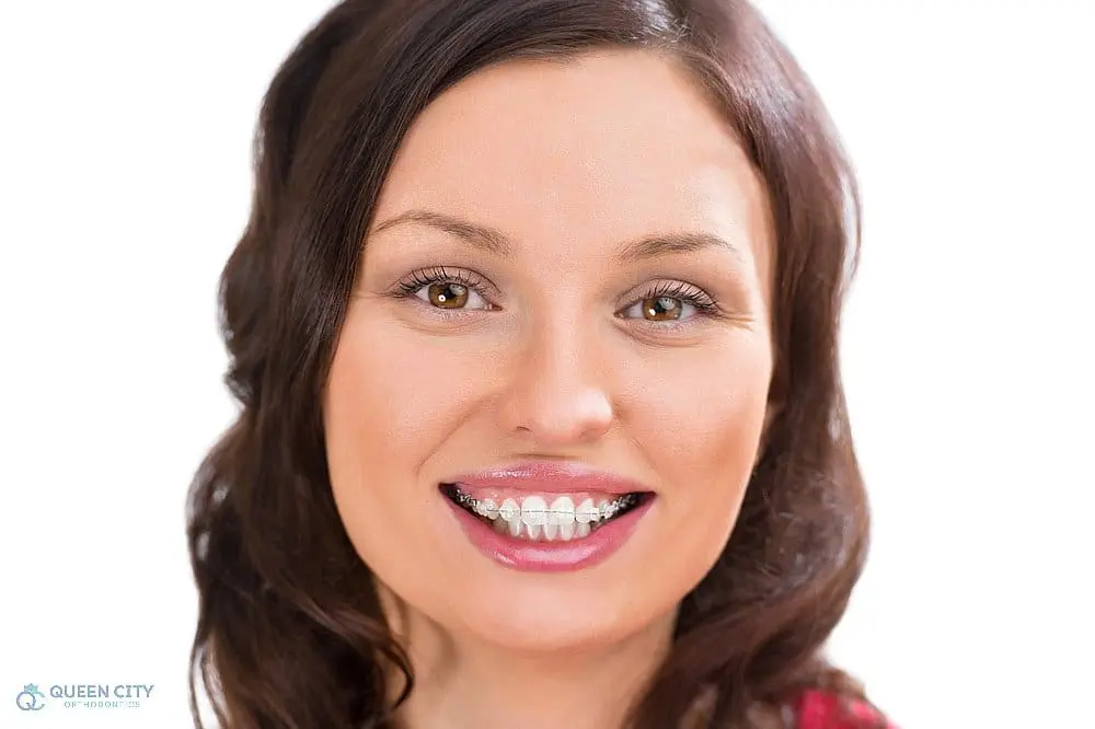 A woman with long brown hair smiles, displaying metal braces at Queen City Orthodontics in Liberty Township or Hamilton, OH - Overbite vs Underbite in Liberty Township and Hamilton, OH.