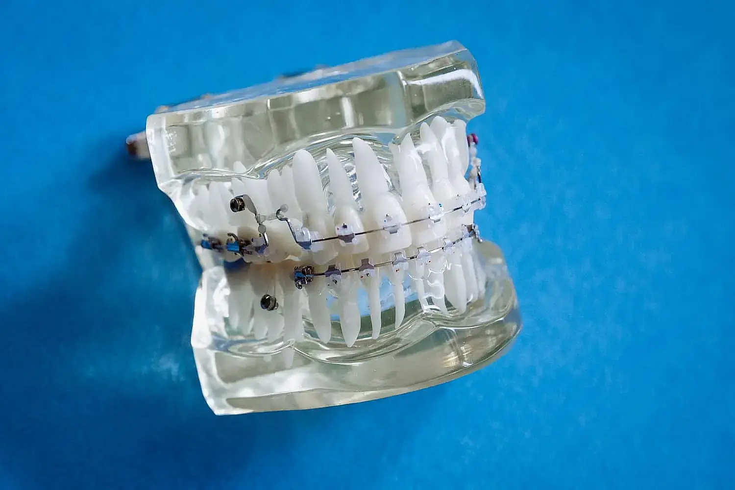 A clear dental retainer with sleek metal braces is elegantly placed on a blue surface in Liberty Township or Hamilton, OH A clear dental retainer with sleek metal braces is elegantly placed on a blue surface in Liberty Township or Hamilton, OH