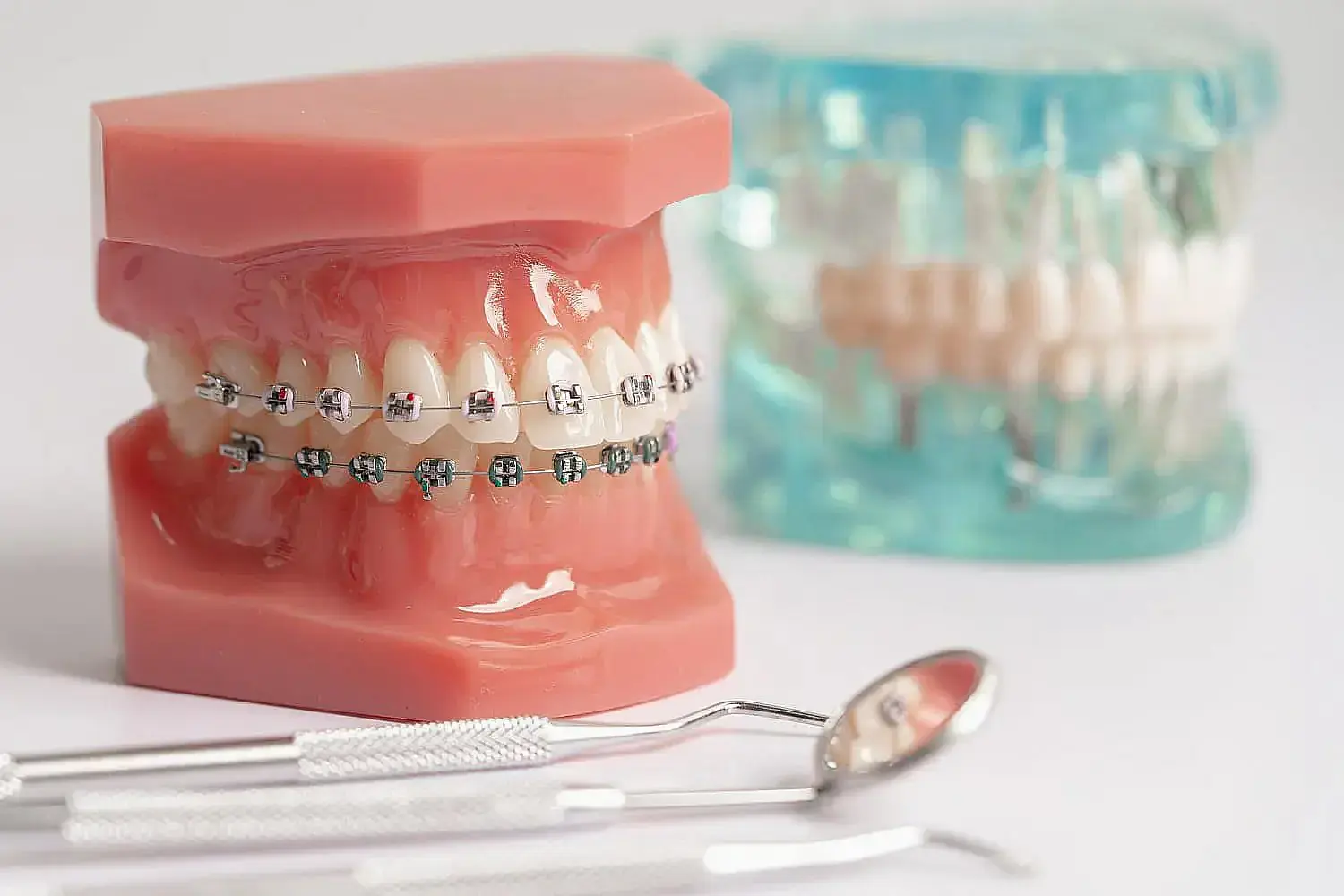 The dental model elegantly displays metal braces on upper and lower teeth, set against a pink gum base in Liberty Township or Hamilton, OH The dental model elegantly displays metal braces on upper and lower teeth, set against a pink gum base in Liberty Township or Hamilton, OH