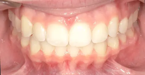 Clean, aligned teeth and healthy gums as seen at Queen City Orthodontics in Liberty Township or Hamilton, OH.