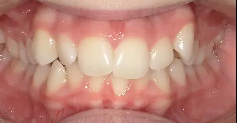 Teeth with crowding and misalignment are shown in a close-up at Queen City Orthodontics in Liberty Township or Hamilton, OH.