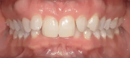 A person's smile with slight dental crowding and mild overbite, treated at Queen City Orthodontics in Liberty Township or Hamilton, OH.
