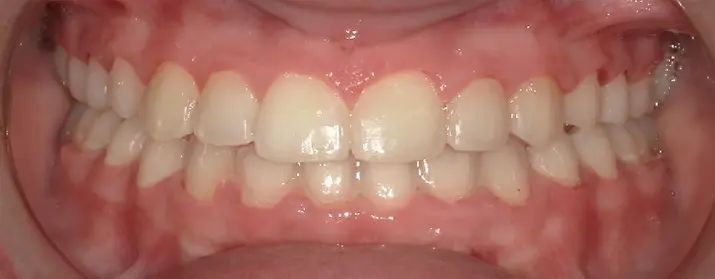 A close-up of a mouth with mild overbite and visible gums, seen at Queen City Orthodontics in Liberty Township or Hamilton, OH.