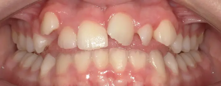 At Queen City Orthodontics in Liberty Township or Hamilton, OH, open mouth shows upper teeth crowding and misalignment; mild lower crowding.