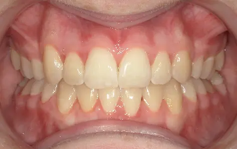 A close-up mouth at Queen City Orthodontics in Liberty Township or Hamilton, OH, displays clean teeth and healthy gums.