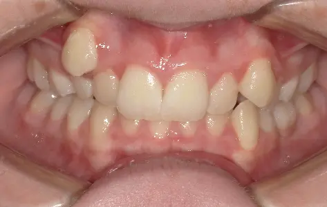 A close-up of misaligned teeth and dental crowding, as seen at Queen City Orthodontics in Liberty Township or Hamilton, OH.