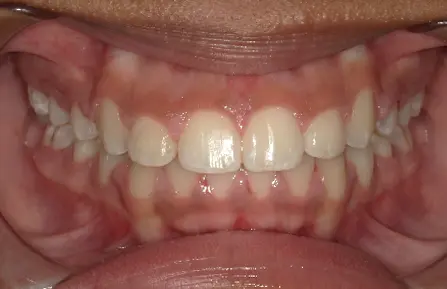 Dental crowding and overlapping teeth shown in an open mouth; Queen City Orthodontics in Liberty Township or Hamilton, OH.