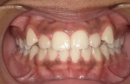 A close-up of teeth and gums with gum pigmentation and alignment, as seen at Queen City Orthodontics in Liberty Township or Hamilton, OH.