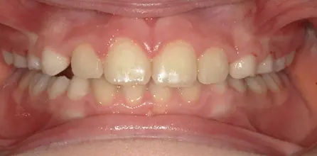 Misaligned, crowded teeth and visible gums shown; Queen City Orthodontics in Liberty Township or Hamilton, OH can help.