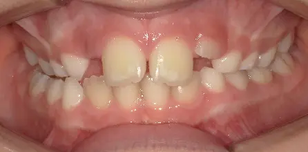 Misaligned, crowded teeth with irregular spacing seen in an open mouth at Queen City Orthodontics in Liberty Township or Hamilton, OH.