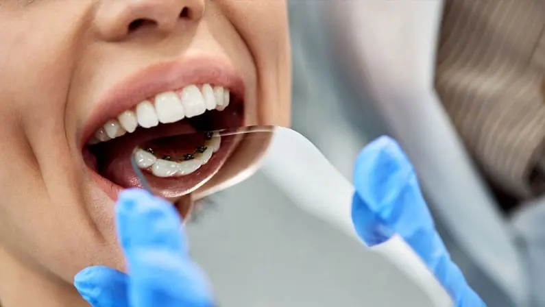 A dentist at Queen City Orthodontics in Liberty Township or Hamilton, OH examines lingual braces inside a patient's mouth.